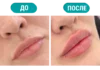 Увеличение губ в Алматы: как проходит процедура и что важно знать перед коррекцией