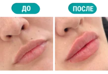 Увеличение губ в Алматы: как проходит процедура и что важно знать перед коррекцией